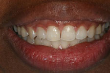 Invisalign 02 - After